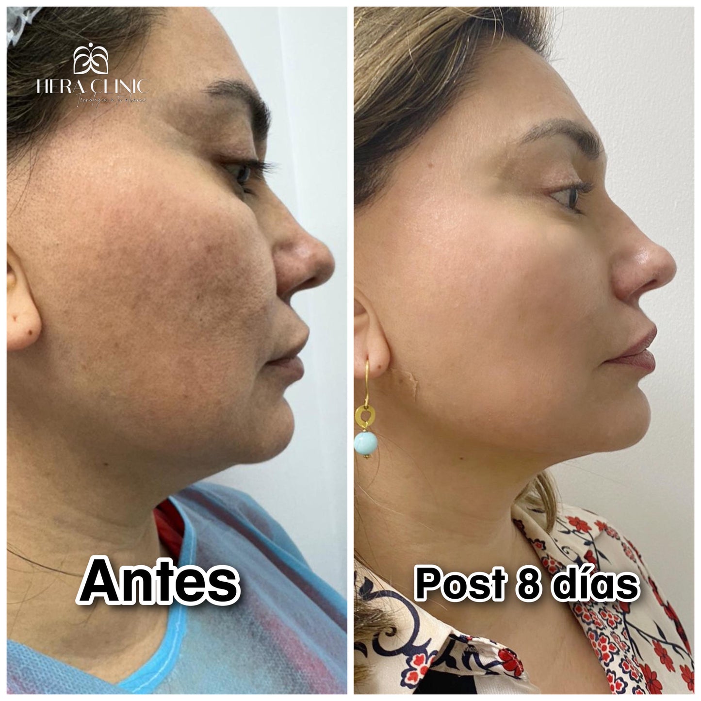 Endolifting facial laser