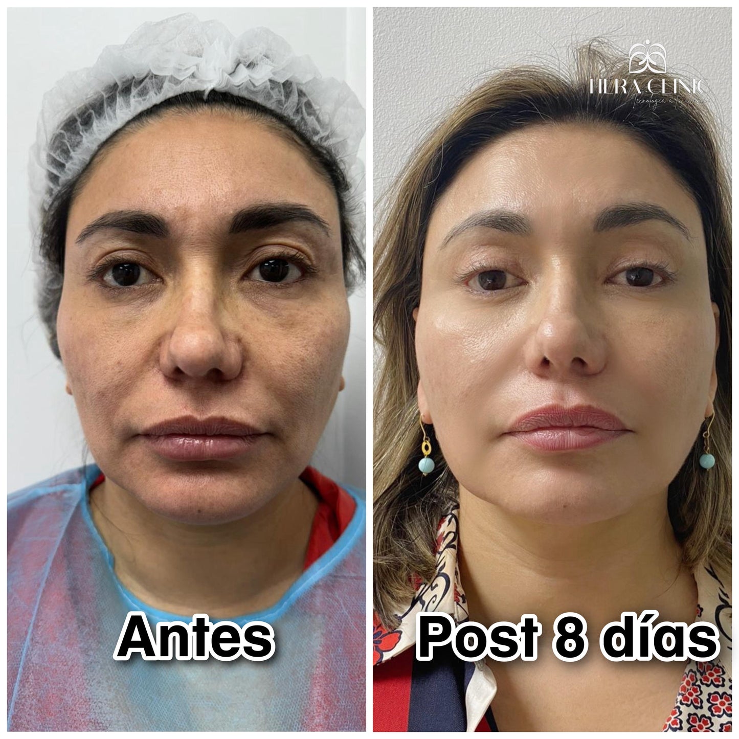 Endolifting facial laser