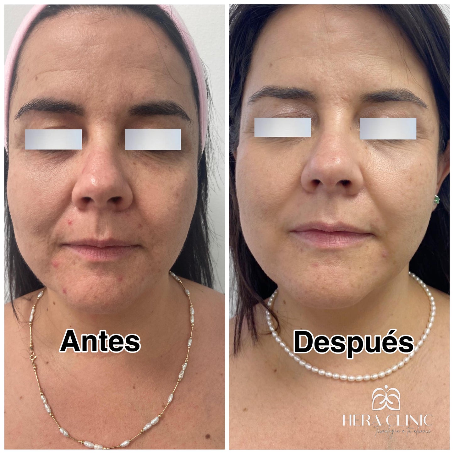 HIFU Facial Lifting sin cirugía