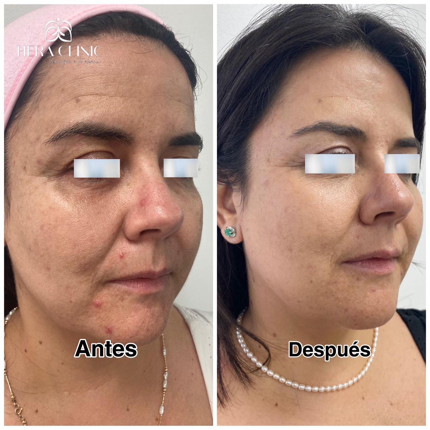 HIFU Facial Lifting sin cirugía